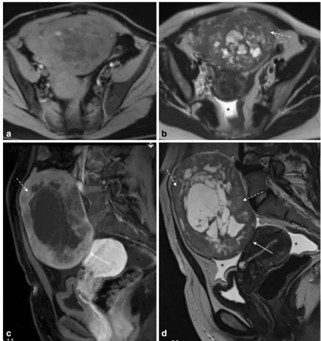 Fig. 16 Cellular fibroma of the right ovary in a 50-year-old female patient. a Axial fat-suppressed T1-weighted image; b Axial  T2-weighted image; c Sagittal fat-suppressed contrast-enhanced  T1-weighted image; d Sagittal T2-weighted image