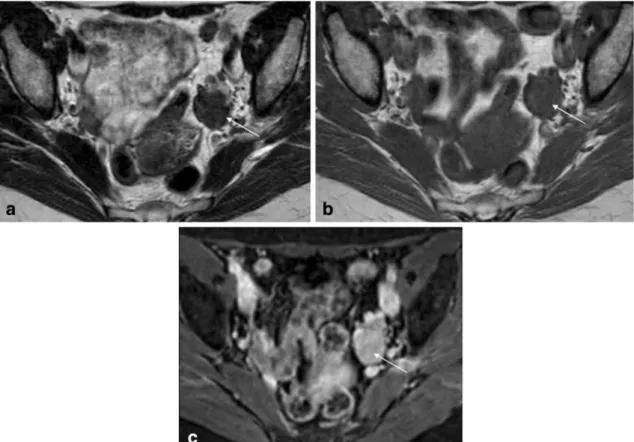 Fig. 18 Brenner tumour of the left ovary in a 58-year-old female patient. a Axial T2-weighted image; b Axial T1-weighted image;