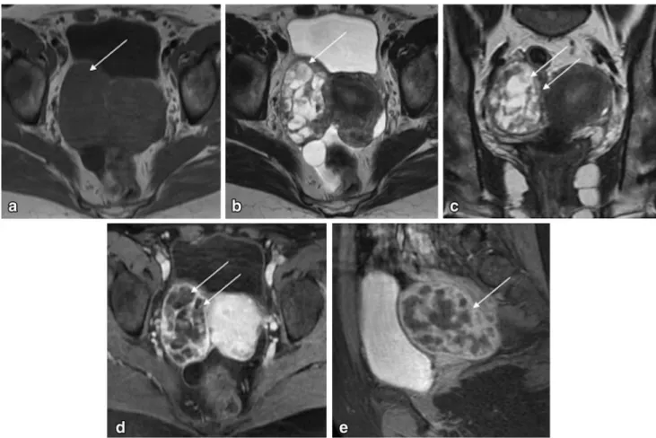 Fig. 20 Parasitic leiomyoma with cystic degeneration in a 47-year- 47-year-old female patient