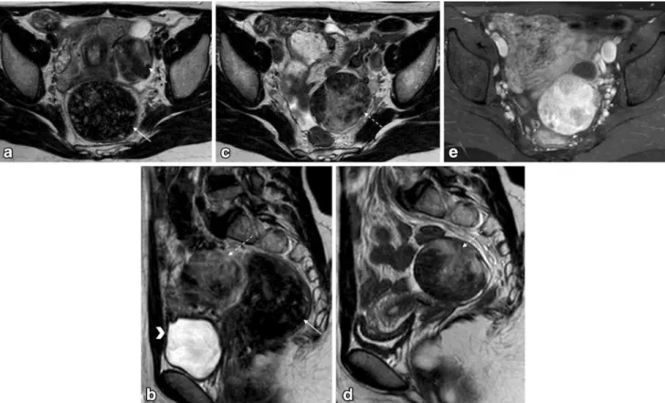 Fig. 2 Pelvic MRI for the characterization of an indeterminate adnexal mass in a 20-year-old woman