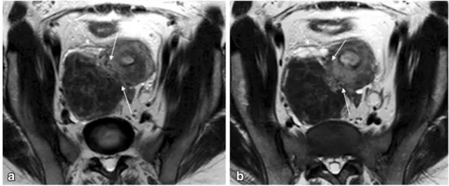 Fig. 4 Bilateral endometriomas in a 44-year-old woman. a Axial T1- T1-weighted image; b Axial fat-suppressed T1-weighted image