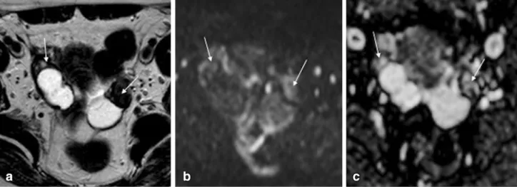 Fig. 6 Bilateral fibromas in a 55-year-old woman. a Axial T2- T2-weighted image; b Axial diffusion-weighted image (b = 1000 s/