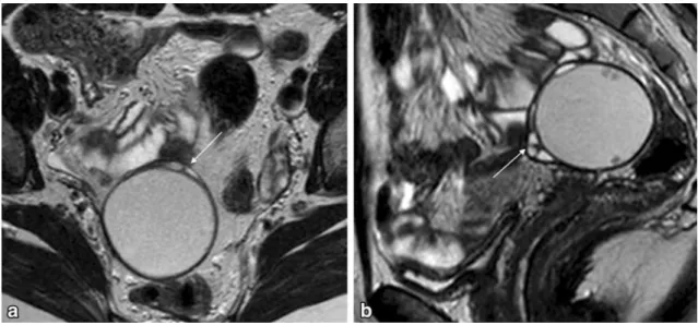 Fig. 11 ‘‘Beak’’ sign a Axial T2-weighted image; b Sagittal T2-weighted image. The ‘‘beak’’ sign occurs when a mass deforms the edge of its organ of origin into a beak shape (arrows)