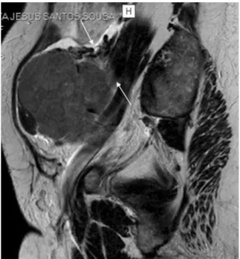 Fig. 14 ‘‘Waist’’ sign caused by a chronic hydrosalpinx in a 74-year- 74-year-old woman