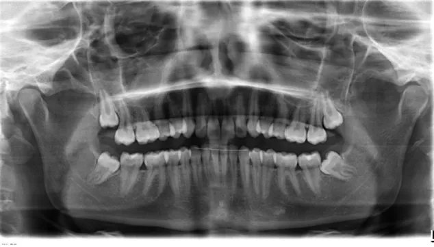 Figura  2.  Ortopantomografia  com  sisos  inclusos  no  maxilar  superior  e  impactados  no  inferior  