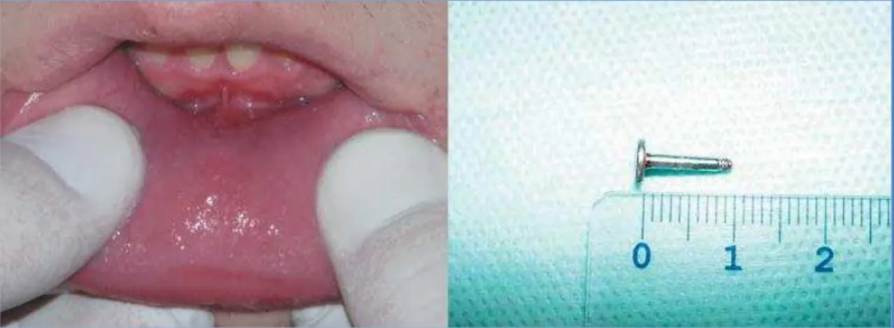Figura 6 - No lado esquerdo pode-se observar a cicatriz na membrana da mucosa do fundo do  vestíbulo; labret após a excisão cirúrgica (Retirado de Antoszewski et al