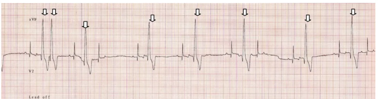 Figure 1 – Ventricular premature complex (VPC) signaled with an arrow. 