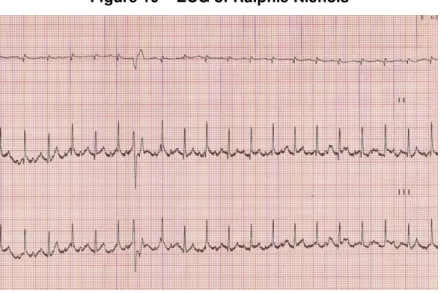 Figure 10 – ECG of Ralphie Nichols 