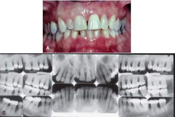 Figura 3. Imagem radiográfica de um paciente com periodontite crónica severa. Observação clínica (A) e  imagem radiográfica correspondente (B)