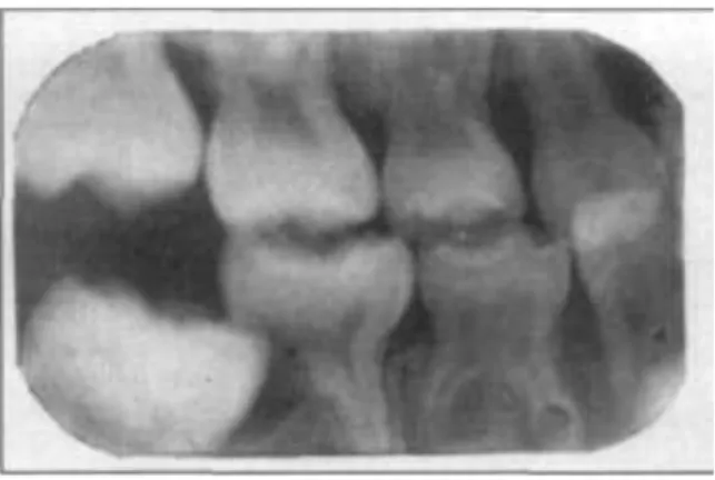 Figura 8 – Erupção ectópica do primeiro molar definitivo inferior com reabsorção da raíz distal  do segundo molar decíduo inferior (in Auychai, Feigal, &amp; Walker, 1981) 