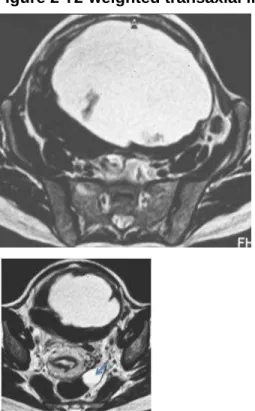 Figure 2 T2-weighted transaxial image. 