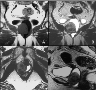 Fig. 7 - A) e C) T2 axial; B) e D) T2 sagital: demonstram a comunicação directa entre a bexiga colapsada e o terço inferior da vagina  (seta).