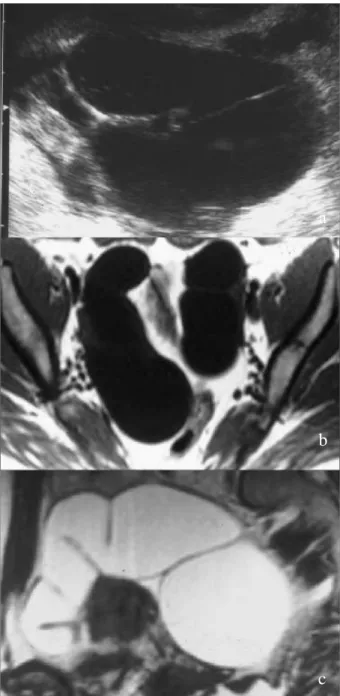 Fig. 1 – Piossalpinge (ecografia transvaginal). Lesão anexial complexa, individualizada  do  ovário  homolateral  (seta),  com  áreas  quísticas contendo ecos e áreas sólidas.