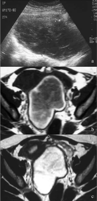 Fig. 6 – Gravidez ectópica tubária de 9 semanas (ecografia transvaginal).