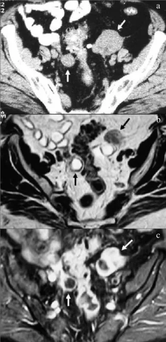 Fig. 8 – Tumor adenomatóide da trompa. Aspecto macroscópico da peça operatória.