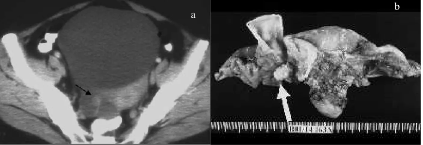 Fig. 10 – Carcinoma seroso tubo-ovárico direito (a) TC; b) peça operatória). Doente pós-menopaúsica apresentava lesão anexial quística direita com uma vegetação sólida, critério de malignidade, reconhecida na peça operatória (seta).