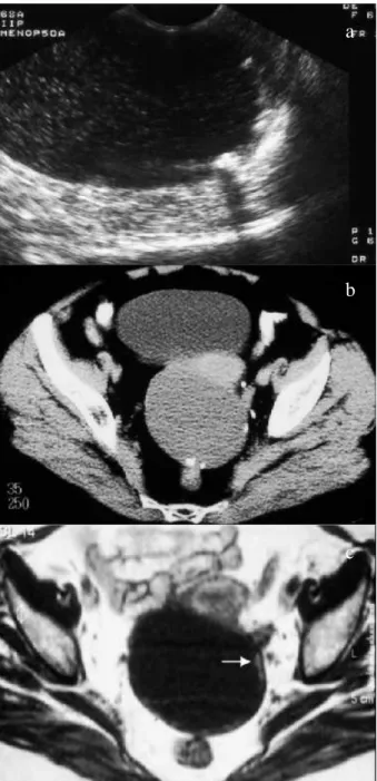 Fig. 12 – Tumor quístico seroso borderline do mesossalpinge esquerdo (a) ecografia transvaginal; b) TC; RM c) T1-Gd)