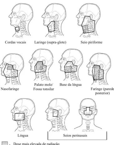 Figura  4  -  Campos  de  radiação  para  as  localizações  mais  comuns  da  patologia  oncológica  da  cabeça  e  pescoço