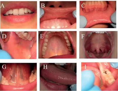 Figura  11  -  Inspeção  intra-oral  (adaptado  de  Azul  et  al.,  2014).  A  -  Observar  o  vermelhão  dos  lábios  superior  e  inferior,  pesquisando  alterações  de  cor,  volume,  entre  outros;  B  -  Retrair  o  lábio  superior  examinando  a  muc