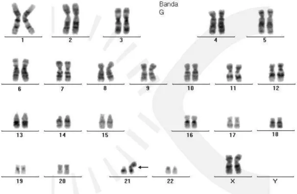 Figura 3 - Cariótipo: 46XX (t 14;21) ou 46XY (t 14;21) - Trissomia por translocação  http://www.chromoscitogenetica.com.br/down.html 