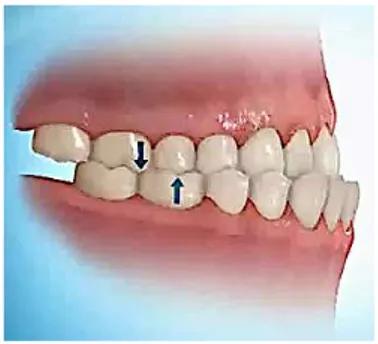 Fig. 4: Classe III dentária. Adaptado de http://www.nanaimobraces.com/aqua.php 