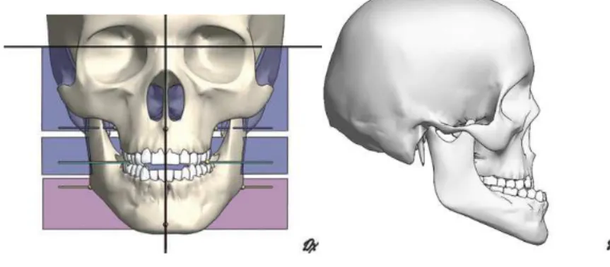 Fig.  6:  Prognatismo  mandibular  simétrico.  Visualização  frontal  (esquerda).  Visualização  lateral  (direita)