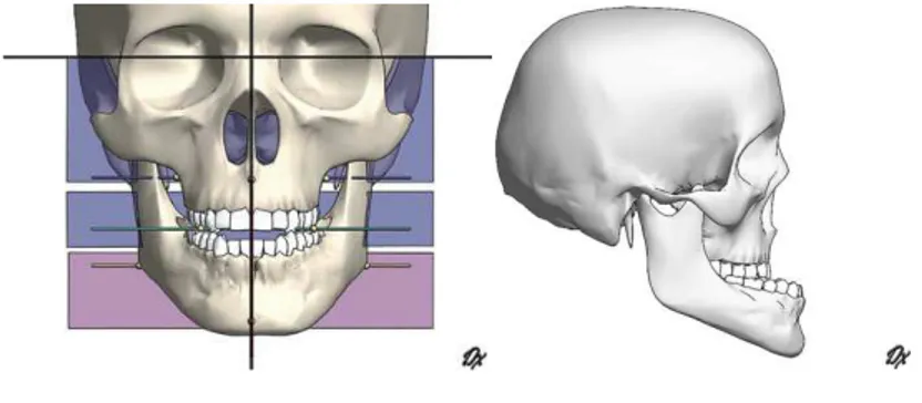 Fig.  9:  Deficiência  maxilar  sagital  com  prognatismo  mandibular  simétrico.  Visualização  frontal  (esquerda)