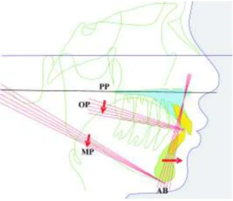 Fig. 16: Impactação molar posterior.  http://www.youtube.com/watch?v=fbtQTn_Izbg 