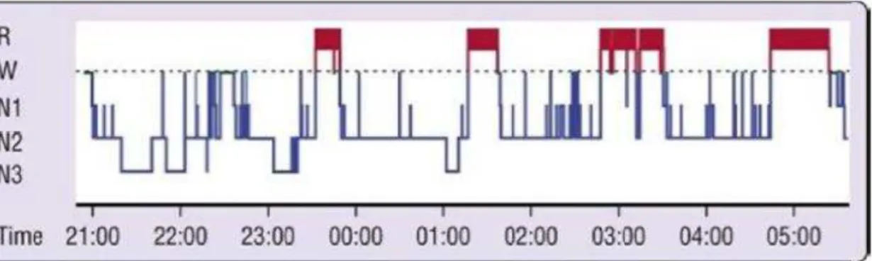 Figura 5 - Hipnograma normal de uma pessoa adulta jovem. Abreviaturas: R= sono REM; W=vigília; N1,  N2 e N3= fases do sono não REM (adaptado de (Keenan &amp; Hirshkowitz, 2011))