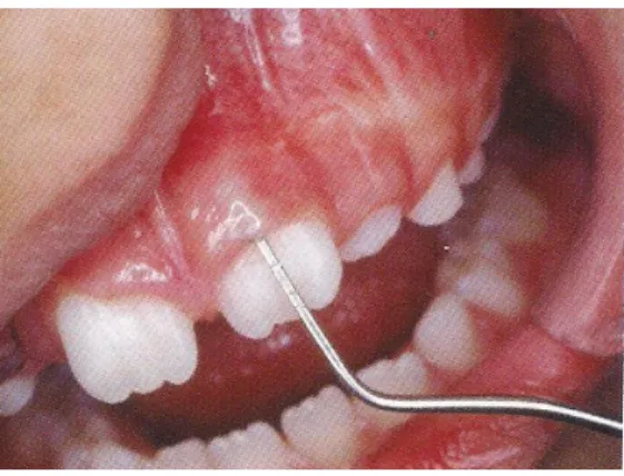 Figura 3 Gengiva clinicamente normal na dentição mista, podendo-se observar a introdução de sonda  milimetrada além dos 3mm