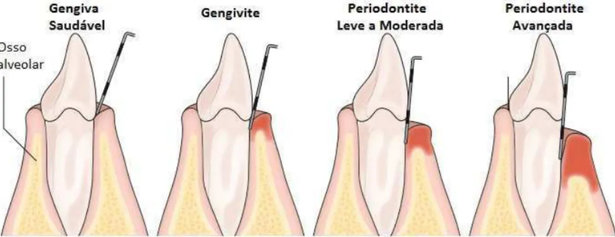 Figura 6. Várias fases da doença periodontal (Traduzido e adaptado de Kinane et al., 2017)