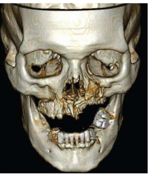 Figura 3 - Reconstrução 3D de lesão de ONJ (maxila e parede anterior do seio maxilar  esquerdo) a partir de imagens de TC em um paciente com mieloma intravenoso tratado com bifosfonatos 