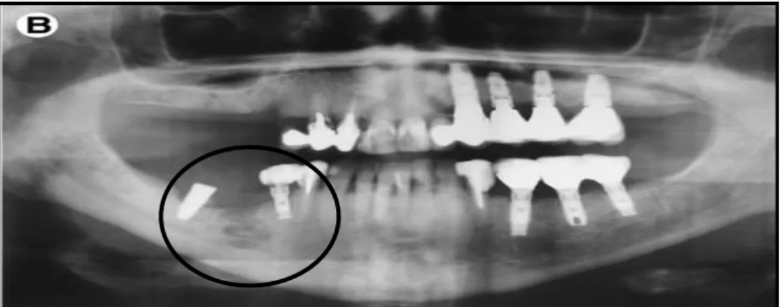 Figura 3 – Ortopantomografia inicial, no momento de diagnóstico de BRONJ. Adaptado de (Curi et al.,  2011) 