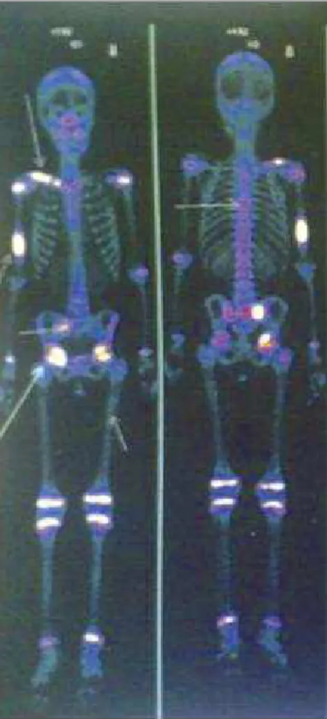 fIguRA 1. Cintigrafia óssea (caso 1): Observam-se sinais de hiperfixação em múlltiplas localizações ósseas – clavícula  direita, isquion e fémur esquerdos; diáfise distal do úmero  direito, articulação coxofemoral direita
