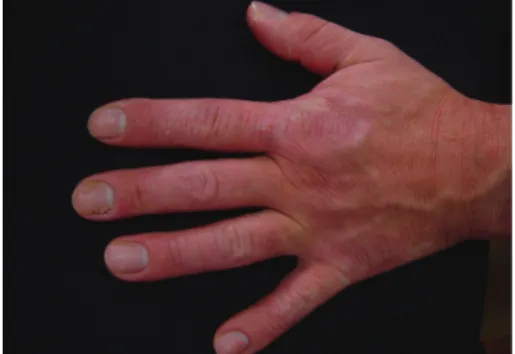 Figure 2: Hand eczema and paronychia (Case 2).