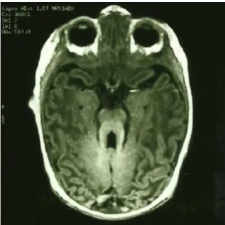 Figure 1 Horizontal MRI T2 section of the brain illustrative of the molar tooth sign.