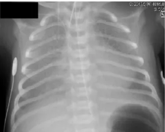 Fig. 2. CT scan at 13 days of life.