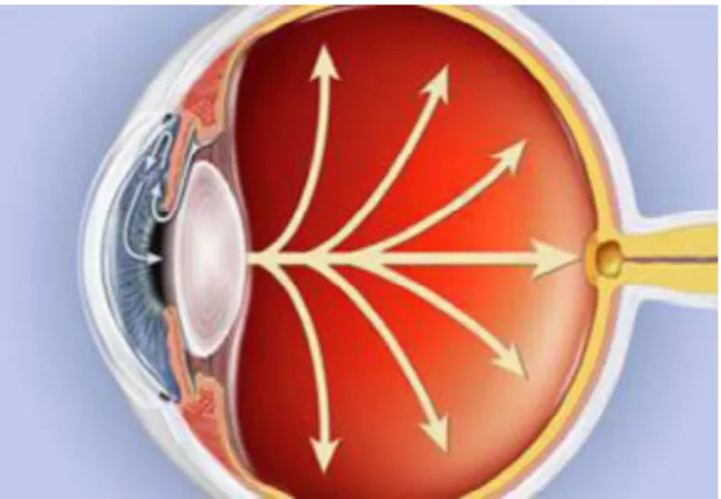 Figura 4 - Estrutura anatómica de um olho identificado glaucoma primário de angulo aberto  Fonte: American academy of ophthalmology  