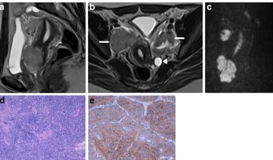 Fig. 5 a – e Cervical small cell carcinoma (FIGO II-A; invasion of the upper two-thirds of vagina with no parametrial invasion)