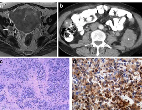 Fig. 8 a – d Undifferentiated endometrial carcinoma with NE differentiation (FIGO III-C1; involvement of pelvic nodes)