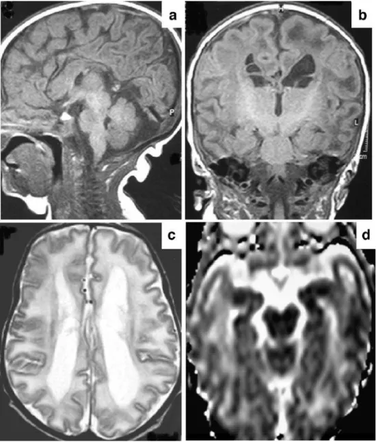 Fig. 1 Brain MRI at 7 days of age. a Mid-sagittal T1-W  spin-echo (TR/TE 624/15 ms) image demonstrates dysgenesis of the corpus callosum