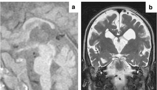 Fig. 2 Brain MRI at 18 months of age. Mid-sagittal T1-W  spin-echo image (a) and coronal T2-W turbo spin-echo image (b) demonstrate a thin callosal body and marked atrophy of the hemispheric white matter