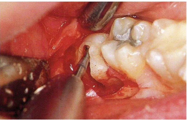 Figura 3 – Odontosecção de terceiro molar inferior direito semi-incluso 