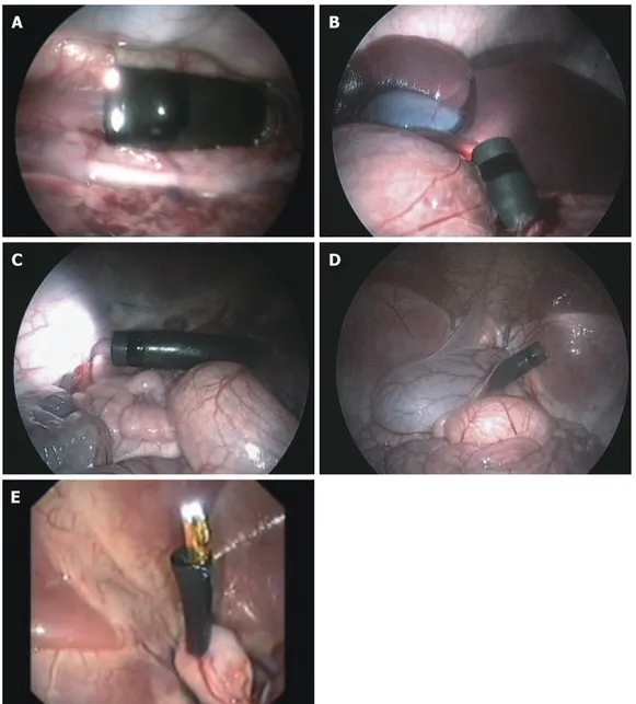Figure  1    Internal  view  of  natural oriice transluminal  endoscopic surgery access  (porcine model)