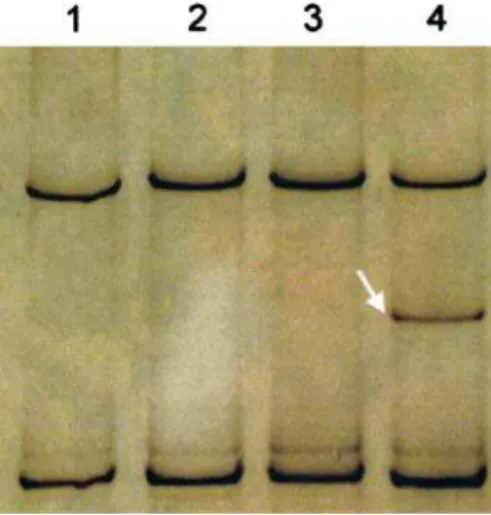 Fig. 2 Sequencing analysis of B-RAF indicating a thymine to adenine substitution at codon 600, resulting in a substitution of a valine to a glutamic acid ( black arrow )