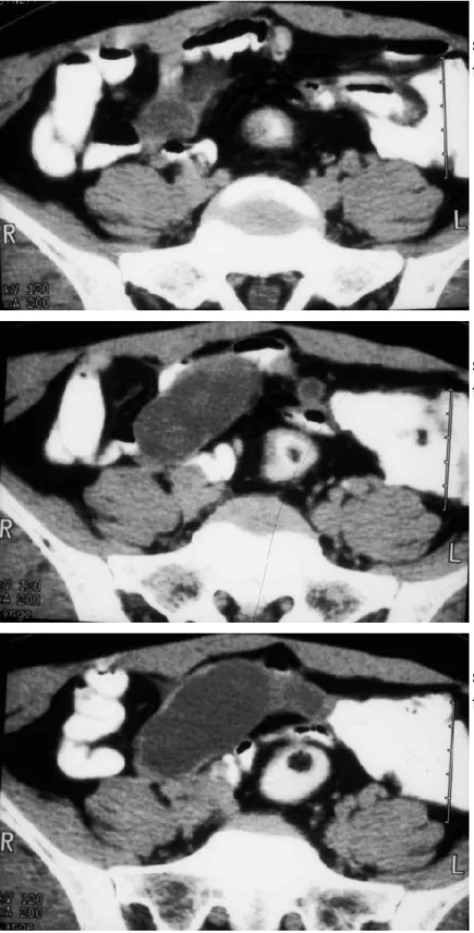 Figure 2 Pelvic CT scan 