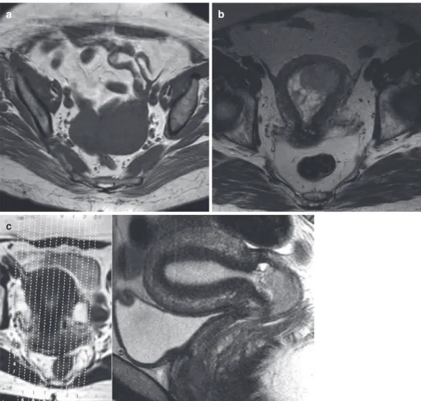 Fig. 1  Examples of different orientations on MRI in dis- dis-tinct patients. Axial T1W image of the pelvis (a)
