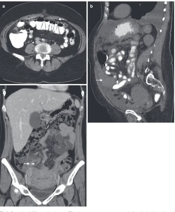 Fig. 2  Examples of different orientations on CT in three  distinct patients. Axial image, after oral and intravenous  contrast administration, depicting anterior peritoneal  carci-nomatosis (arrow) in a patient with endometrial carcinoma  ( a )