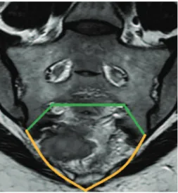 Figure 2: Previewed en bloc excision of the tumor on coronal MRI.