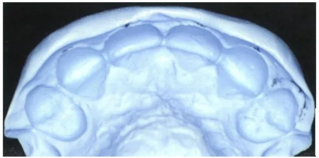 Figura 7: Matriz de silicone (Ramos et alii, 2009) 